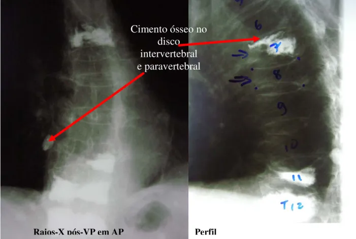 Figura 9. Imagens obtidas com Rx (em perfil e AP) do segmento torácico da coluna após a VP,  mostrando o  extravasamento  assintomático  do cimento ósseo para o disco intervertebral e região  paravertebral (VPs n os 