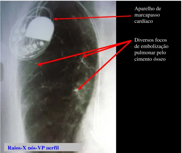 Figura 10. Imagens obtidas com Rx (em perfil) do segmento torácico da coluna após a  VP realizada em outra cidade,  não incluída nesta Tese, mostrando o  extravasamento  sintomático do cimento ósseo para os pulmões