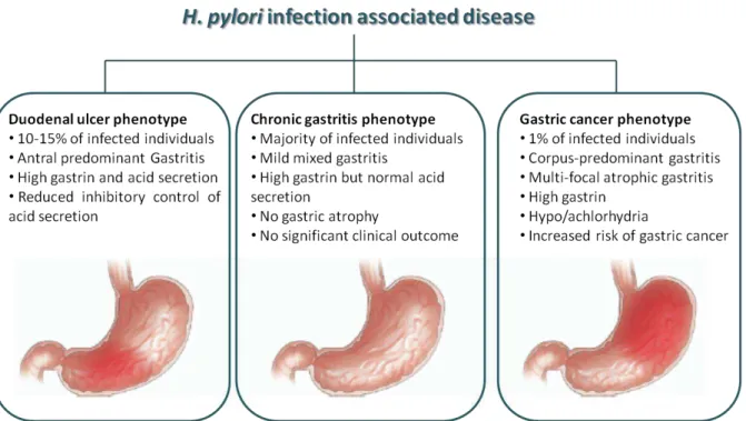 Figure  1.5.1  –   Chronic  H.  pylori  infection:  Chronic  H.  pylori  infection  can  lead  to  different  gastric  diseases  such  as  chronic  gastritis,  duodenal  ulcer  and  gastric  cancer