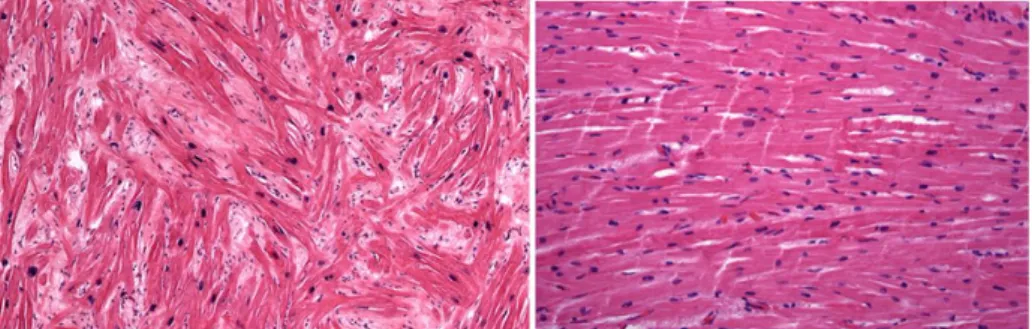 Figura 1.12  –  Histopatologia de cortes transversais do miocárdio demonstrando desarranjo e hipertrofia de cardiomiócitos e  ainda  fibrose  intersticial  (esquerda)  característicos  de  MH,  comparativamente  com  a  estrutura  organizada  do  miocárdio