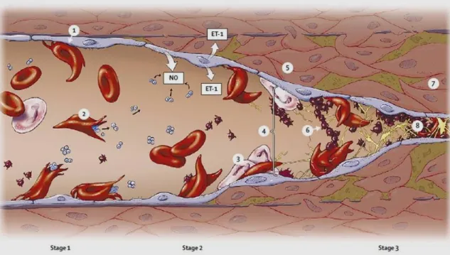 Figure I.10.: Pathophysiology of stroke in SCD.  The abnormal adherence (1) and high rate hemolysis (2) of  the sickle erythrocytes are the basis for the development of cerebrovascular disease in patients with SCD