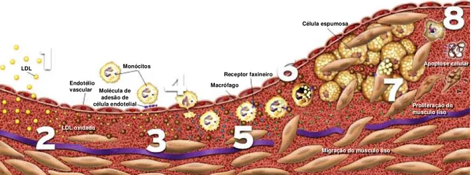Figura 5 -  Estágios do desenvolvimento de uma placa aterosclerótica. 