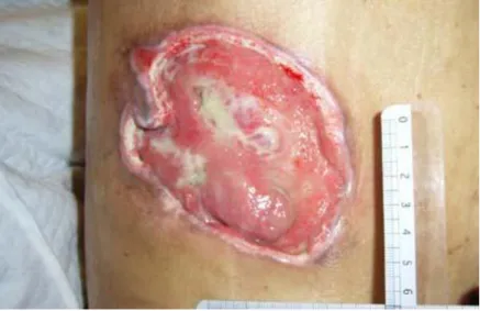 Figura 4: Lesão no estágio IV (Fonte: http://www.curamed.com.br/). 
