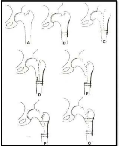 Figura 2 - Técnica cirúrgica descrita por Papavasiliou et al  10 : a) coxa brevis; b) fixação  da placa com dois parafusos distais; c) osteotomia longitudinal fêmur proximal; d-e)  deslizamento da osteotomia do fêmur; f-g) fixação com dois parafusos proxim