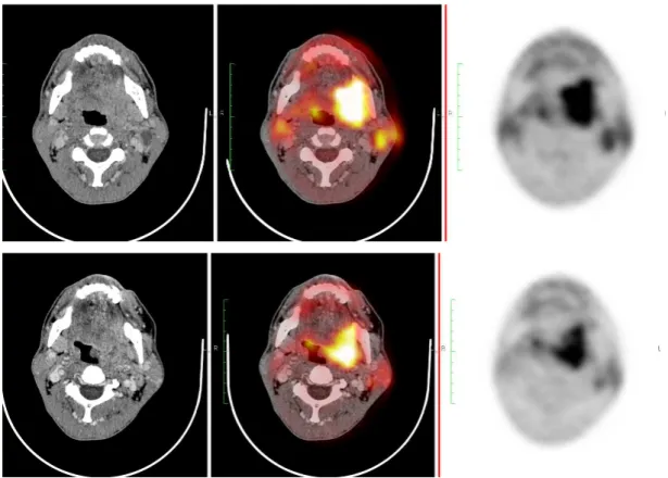 Figura 1. Paciente 3: PET1 (linha superior) e PET2 pós-quimioterapia de indução (linha inferior)  mostrando redução volumétrica e metabólica da lesão tumoral