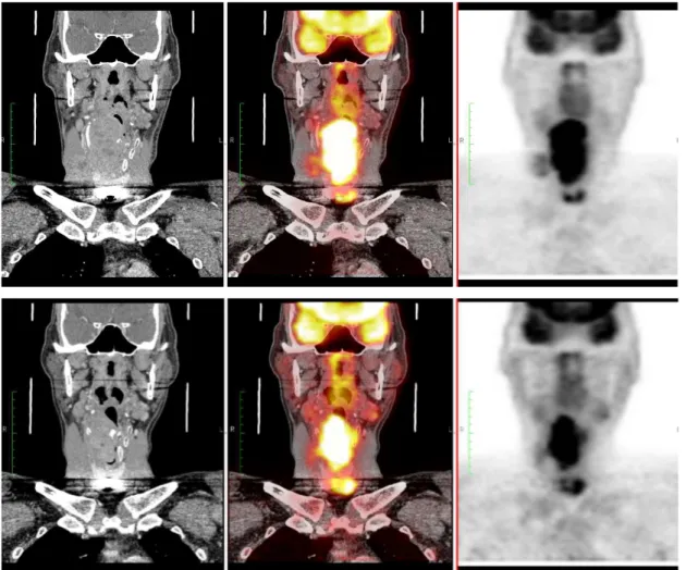 Figura  2.  Paciente  2:  PET1  (linha  superior)  e  PET2  pós-quimioterapia  de  indução  (linha  inferior)  mostrando  redução  volumétrica  e  metabólica  da  lesão  tumoral  na  análise  visual