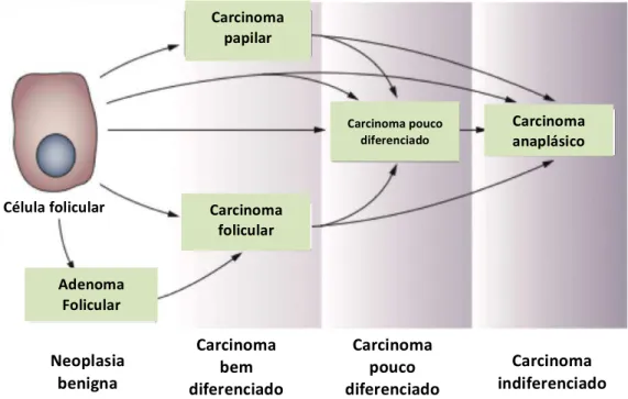 Figura  I-6  –  Esquema da progressão e desdiferenciação das células foliculares derivadas do cancro da tiróide  (adaptado de Nikiforov e Nikiforova, 2011)