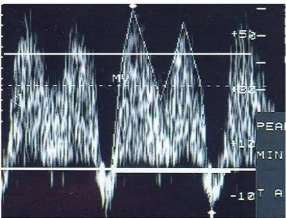 Figura 3 - Sonograma do ducto venoso com fluxo reverso na onda a 