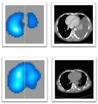 Figura  2  -  Demonstração  da  resolução  espacial  da  TIE  e  da  tomografia  computadorizada de raio X 