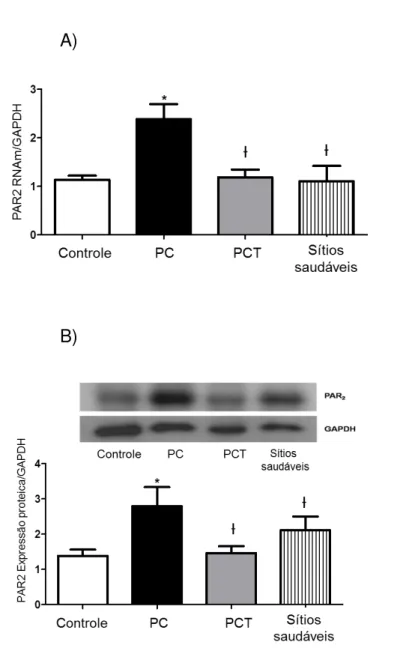 Figura 5.1 - Expressão do RNAm do PAR2 no FG dos grupos controle, periodontite crônica (PC) antes  e  depois  do  tratamento  periodontal  não-cirúrgico  (PCT),  e  sítios  saudáveis  do  grupo  periodontite crônica (PC) (A)