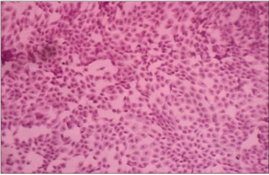 Figura 20 - CI apresentando feixe de células epiteliais coesas, com relação núcleo- núcleo-citoplasma 1/1 e 1/2, mucina e células caliciformes íntegras