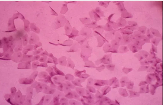 Figura 27 - CI revela metaplasia escamosa avançada (Classe C), representada por células epiteliais com perda da coesão intercelular, relação núcleo citoplasma até 1/8, predomínio de núcleos picnóticos, sinais de queratinização (células com bordos citoplasm