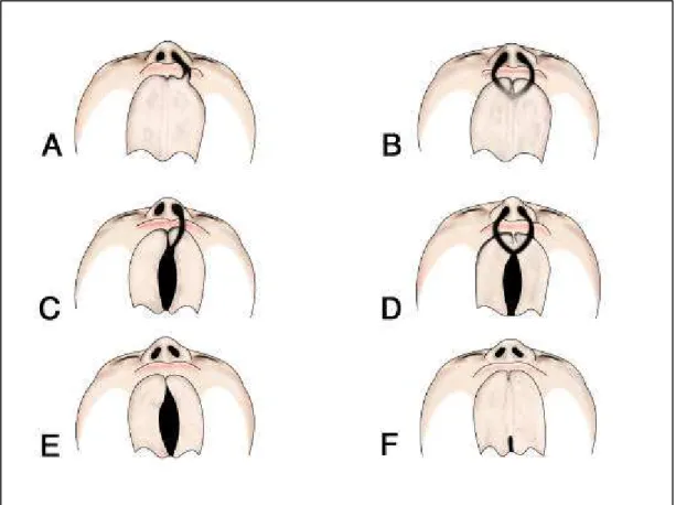 FIGURA 1 –  Diferentes tipos de fissuras de lábio e/ou palato: A) fissura de palato  primário – fissura unilateral pré-forame incisivo incompleta; B) fissura  de palato primário – fissura bilateral pré-forame incisivo completa; C)  fissura de palato primár