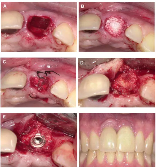 Figura  2  -  Técnica  cirúrgica  de  enxertia  com  Bio-Oss  na  maxila  anterior.  (A)  extração  do  incisivo central superior exibindo perda óssea importante, o que inviabilizaria a colocação do  implante de titânio; (B) osso bovino inorgânico compacta