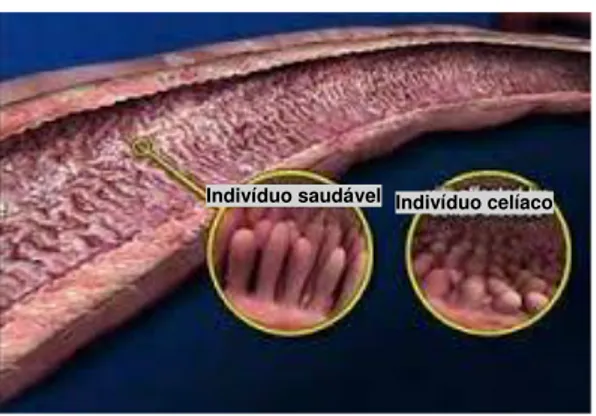 Figura 1  –  Mucosa intestinal de um indivíduo saudável e de um indivíduo celíaco. 