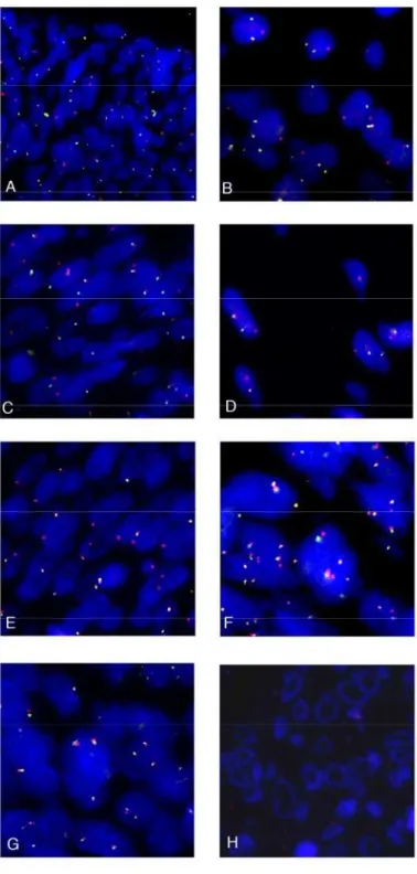 Figura 8. Microfotografia do rearranjo de SS18 por FISH – casos positivos  (A);  (B);  (C); (D); - perda de uma sonda verde (E) – múltiplas cópias de  SS18 (F) – caso negativo (G) – ausência de sinal, impróprio para avaliação  (H) 