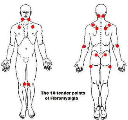 Figura 1 - Localização anatômica dos 18 tender points. 
