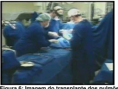 Figura 6: Imagem do transplante dos pulmões   de Eloá em garota de 18 anos 