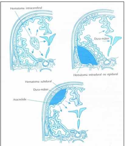 Figura 1 – Hematoma Intracerebral, Epidural e  Subdural 