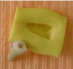 Figura 4.4 – Raiz com um pequeno reservatório de resina composta fotopolimerizável na  porção cervical e o posicionador de silicone em posição proximal 