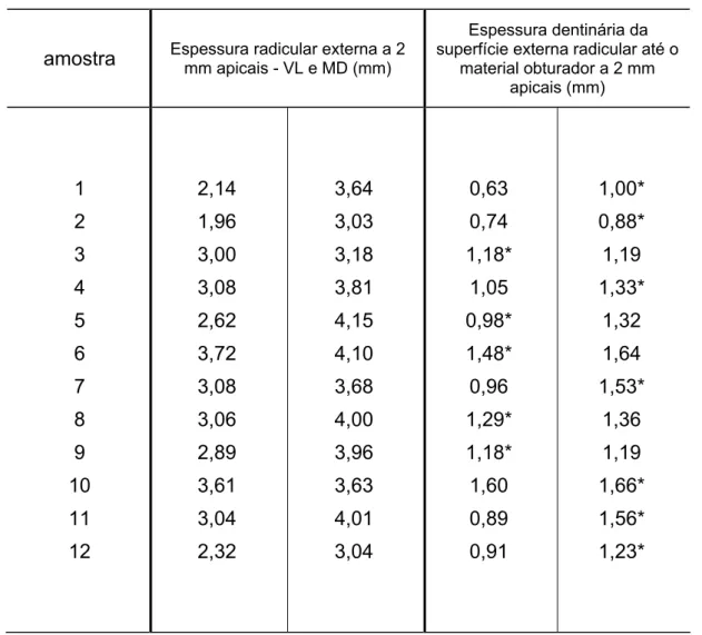 Tabela 5.2 – Análise da espessura radicular externa a 2 mm apicais (VL e MD) e a espessura  dentinária da superfície externa radicular até o material obturador (superfície interna do  canal) a 2 mm apicais 