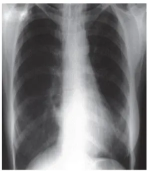 Figura  9: Radiografia  ao  toráx  de  uma  pessoa  com  tuberculose pulmonar extensa (Marrques, 2007)