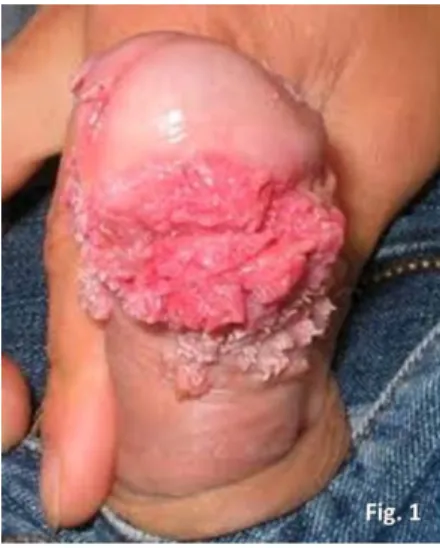 Figura 1 Condilomas acuminados do pénis causados por HPV 