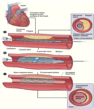 Figura nº 2 – Angioplastia com colocação de 