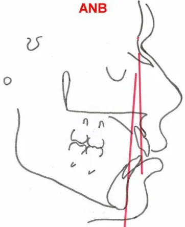 Figura 4.3  -  Ilustração do ângulo ANB 
