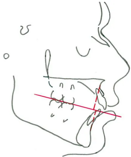 Figura 4.4  -  Ilustração da avaliação Wits com o Plano Oclusal 