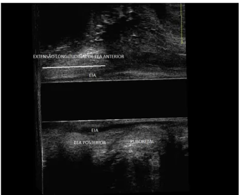 Figura  6.  Limites  anatômicos  da  extensão  longitudinal  de  esfíncter  externo  do  ânus  anterior,  em  corte  sagital