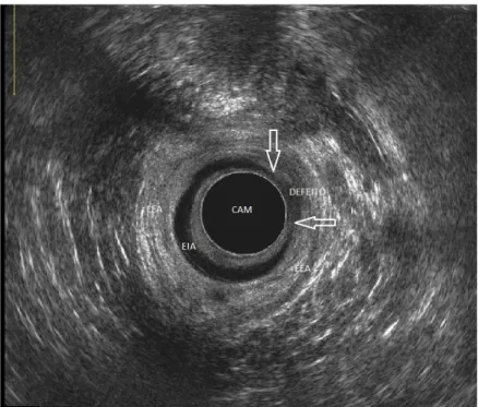 Figura 10. Aspecto ultrassonográfico de defeito de esfíncter interno do ânus no plano radial  em canal anal médio