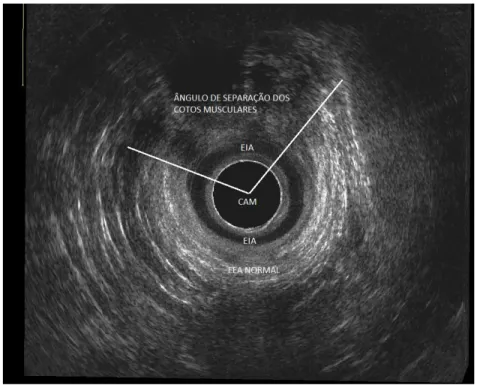 Figura  11.  Aspecto  ultrassonográfico  da  medida  do  ângulo  de  separação  dos  cotos  de  esfíncter  externo  lesado,  no  plano  radial  em  canal  anal  médio