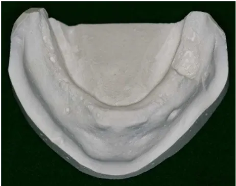 Figura 5: Modelo de gesso adquirido a partir de moldagem da mandíbula seca.  