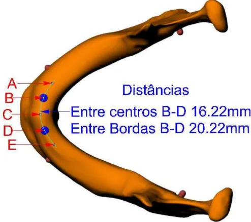 Figura 7: Esquema representando a instalação de implantes nas posições B e D e  suas distâncias representando o Modelo Padrão