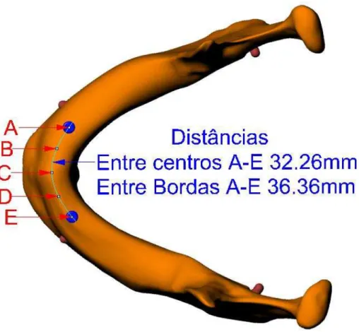 Figura 8: Esquema representando a instalação de implantes nas posições A e E e  suas distâncias representando o Modelo Alternativo.