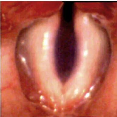 Figura 2: Imagem das pregas vocais femininas durante a respiração obtida através de vídeo de  alta velocidade