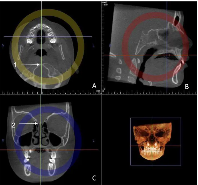 Figura  2-  Ajuste  manual  aproximado  das  imagens  (A)  axial;  (B)  sagital;  (C)  coronal