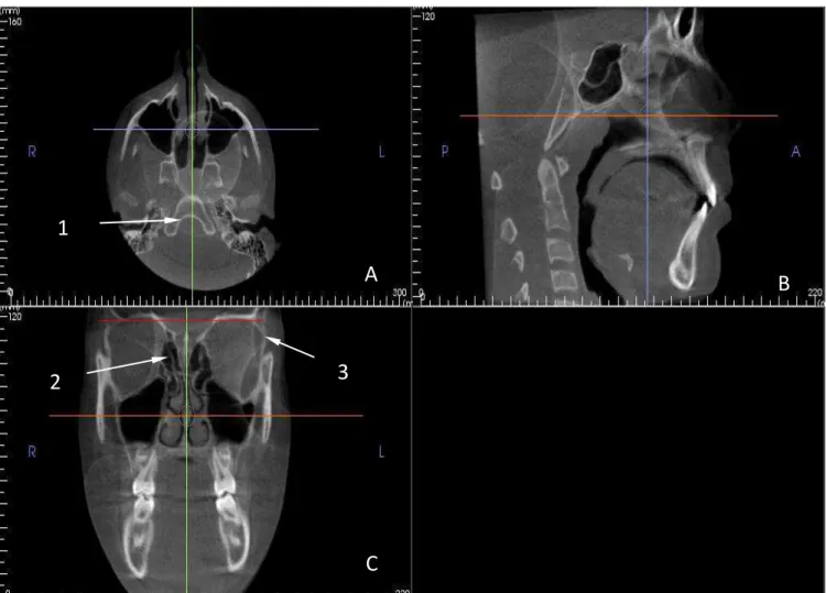 Figura 3- A- Corte axial; B- Corte sagital; C- Corte coronal; As setas indicam; o forame magno (1), crista galli (2) e a linha  de referência horizontal passando na borda superior das órbitas direita e esquerda, paralela ao solo (3)