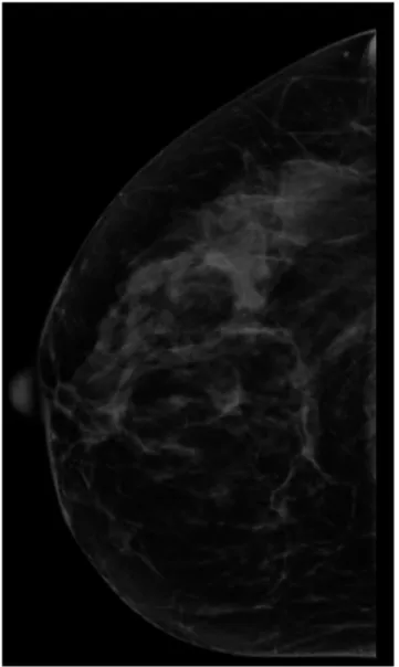 Figure 2. Full-field digital mammography image with 1-mm simulated blur.
