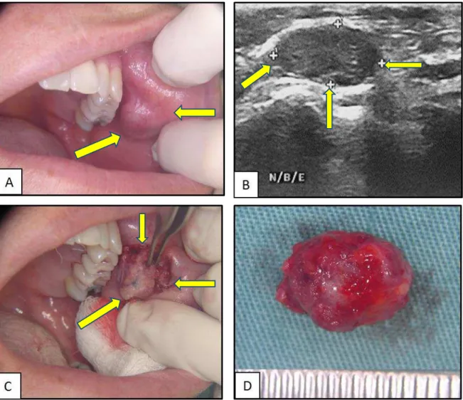 Figura 4: Nódulo inespecífico na mucosa jugal esquerda, com 2 meses de evolução, incluído na  amostra  (A)