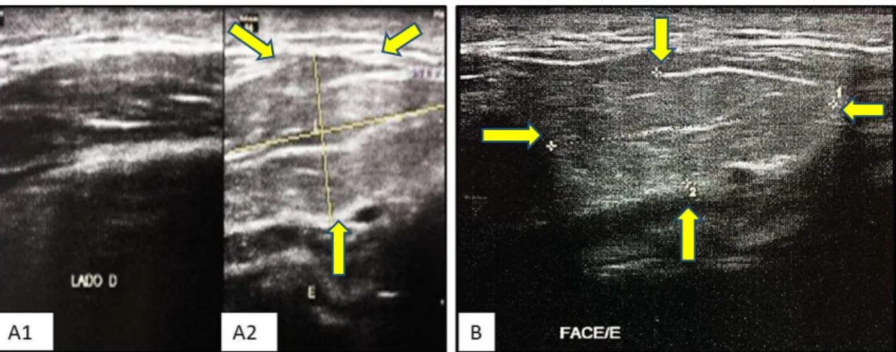 Figura 6: Imagem ultrassonográfica comparativa entre o lado direito e esquerdo da face do  paciente referido na figura 5 (A1 e A2)