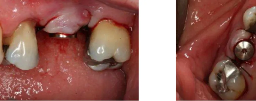 Fig. 9  – Cirurgia de instalação do implante finalizada com a colocação da tampa  de cicatrização e sutura