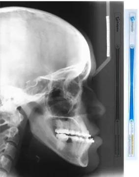 Figura 1: Régua graduada em 10 cm de um ponto ao outro própria do software Dolphin Imaging 3D v