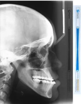 Figura 1: Régua graduada em 10 cm de um ponto ao outro própria do software Dolphin Imaging 3D v