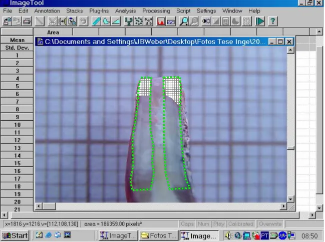 Figura 2 - Imagem digitalizada no software Image Tool ® , com Vitremer ®  Fonte: dados da pesquisa (PUCRS; 2005) 