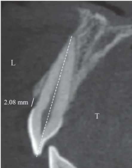 Figure 6- A: Medida da espessura da gengiva vestibular na imagem do  paciente com um biótipo periodontal grosso (ST-CBCT)