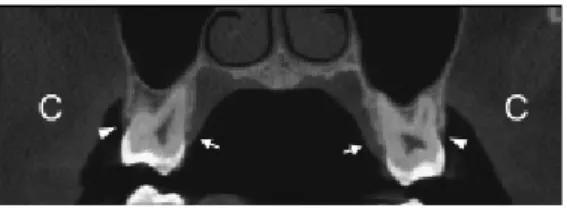 Figura 4. Representação da imagem da tomografia computadorizada de feixe  cônico e exibição das precisas medidas obtidas com o programa iCat de  acordo com as posições indicadas na Figura 2