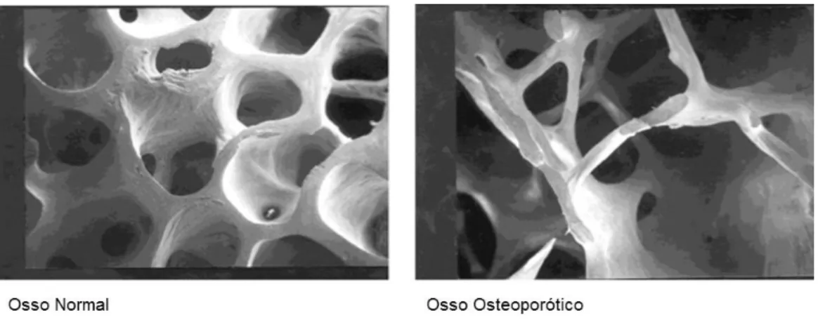 Figura  1.  Micrografias  comparando  o  osso  normal  (esquerda)  com  o  osso  osteoporótico  (direita)