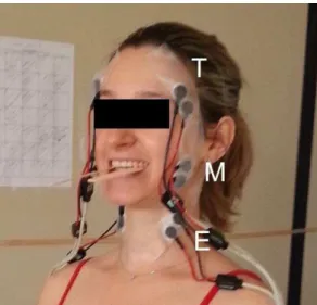 Figura  6.  Avaliação  do  Sinal  Eletromiográfico  (SEMG)  da  Contração  Isométrica  Voluntária  Máxima  (CIVM): M) Masseter, T) Temporal (fibras anterior), E) Esternocleidomastóideo (terço médio)